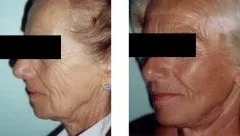Lifting facciale – prima e dopo